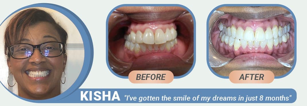 Kisha before and after Invisalign treatment