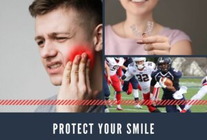 Mouthguards