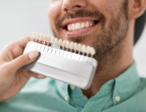 Everything You Need to Know About Dental Veneers